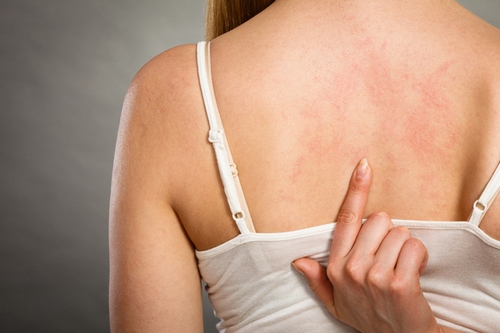 Dầu dừa có tính sát khuẩn nên thường dùng để trị 1 số bệnh ngoài da