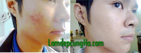 trị mụn bằng dầu dừa