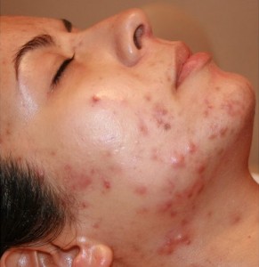 Mụn nội tiết thường nổi xung quanh quai hàm, cằm