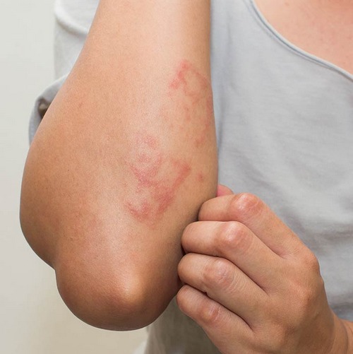 Cách Chữa Bệnh Chàm Eczema Hiệu Quả Với Dầu Dừa [Chia Sẻ]