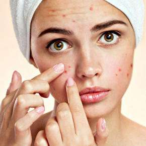 Cách Trị Mụn Hiệu Quả và Trị Vết Thâm Trong 2 Tuần [Kinh Nghiệm]